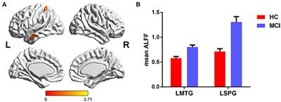 Aggregation of Vascular Risk Factors Modulates the Amplitude of Low-Frequency Fluctuation in Mild Cognitive Impairment Patients